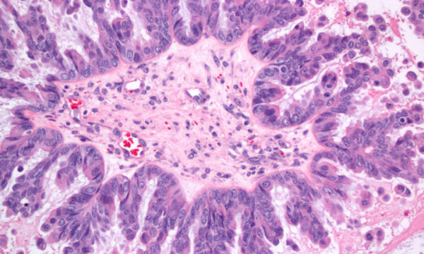 This is a hematoxylin eosin-stained section of an ovarian tumor at 200x magnification. The cells surrounding the central core form thin, filiform micropapillae--an arrangement known as the "Medusa head." The presence of micropapillary features indicates aggressive behavior in an ovarian serous borderline tumor.